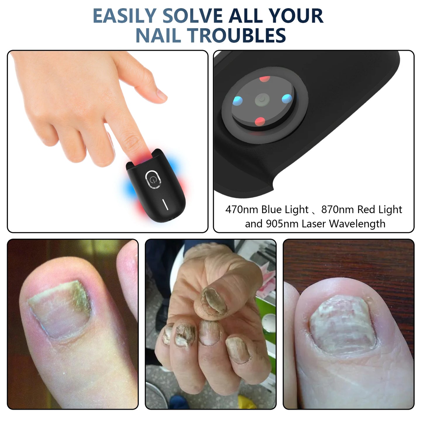 KTS Nail Fungus Laser Device Toenail Laser Therapy Machine