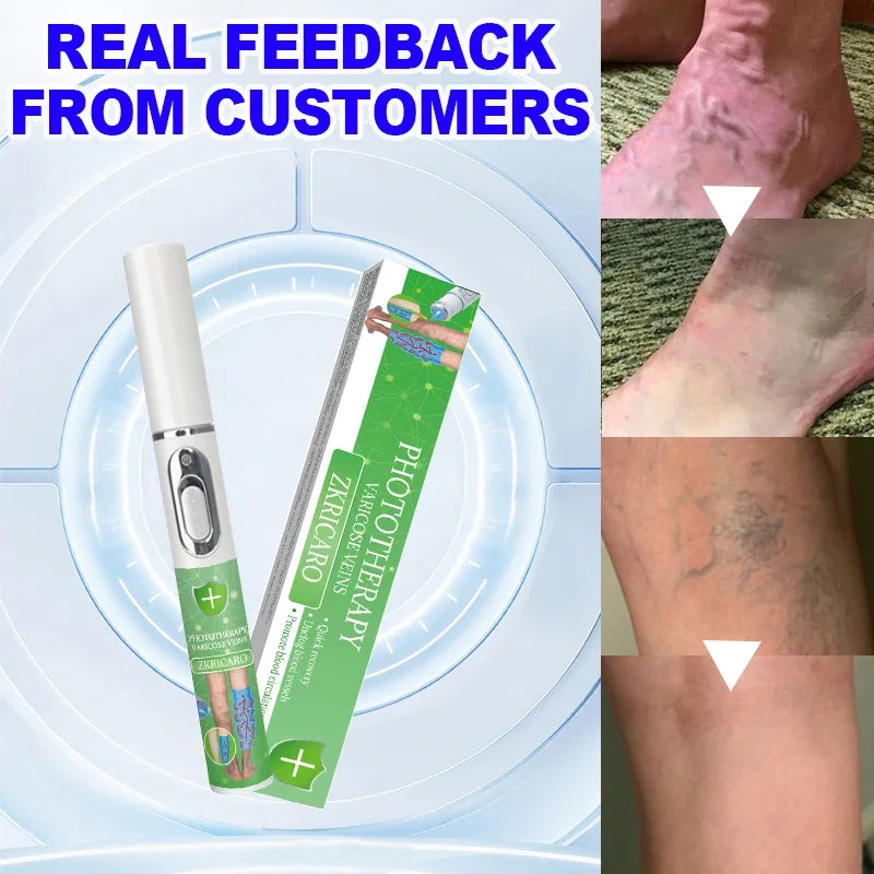 High tech Laser therapy improves moderate varicose veins relieves pain and Improves circulation for men women - Supersell 