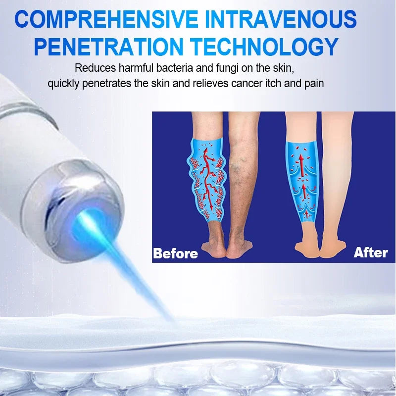 High tech Laser therapy improves moderate varicose veins relieves pain and Improves circulation for men women - Supersell 