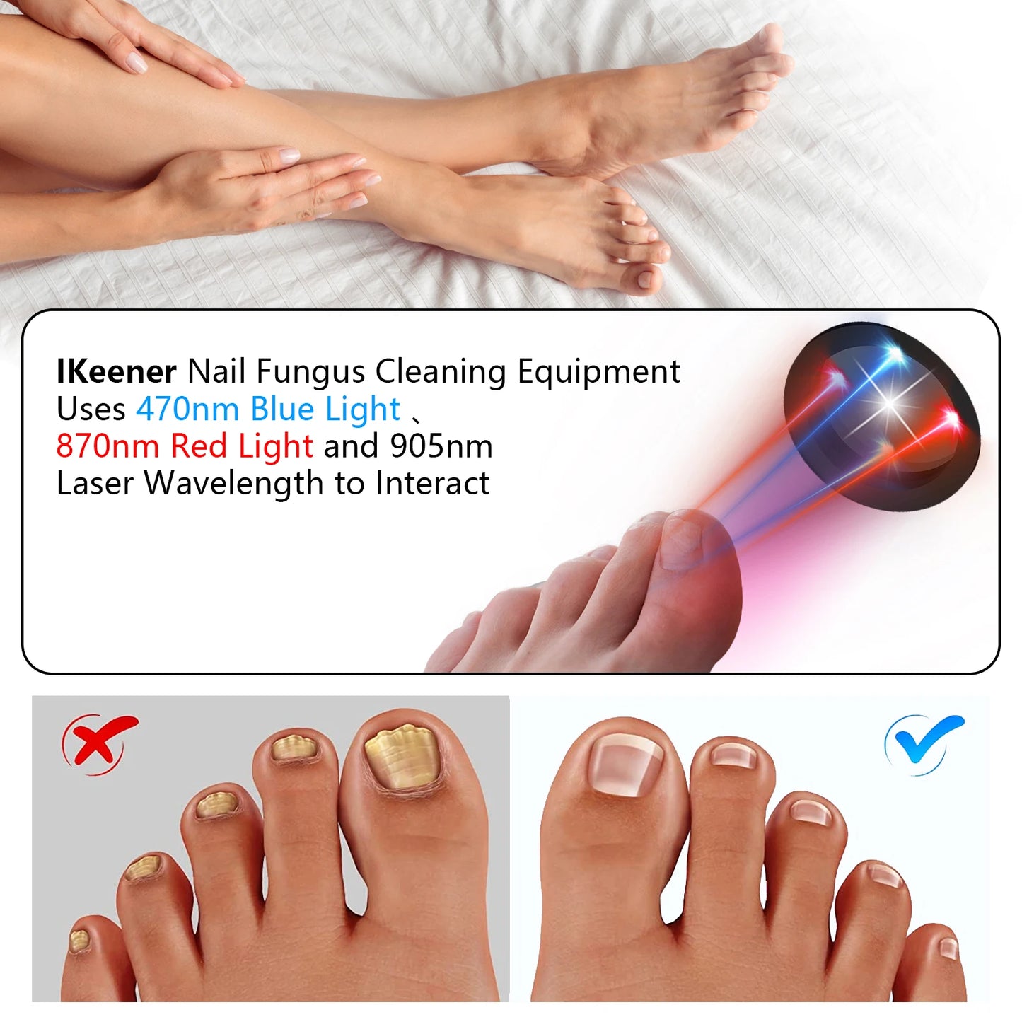 KTS Nail Fungus Laser Device Toenail Laser Therapy Machine